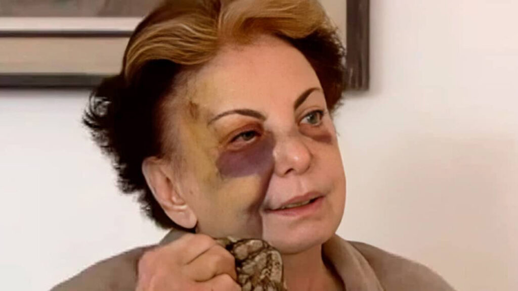 Beatriz Segall após sofrer queda numa rua do Rio de Janeiro